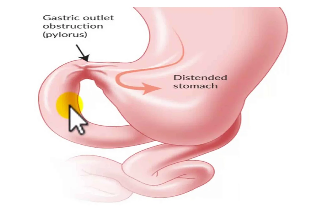Gastric Problems